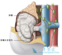 肾癌“偏好”吸烟男人多饮水多运动赶走肾癌