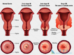 哪些是宫颈癌患者会出现的主要症状